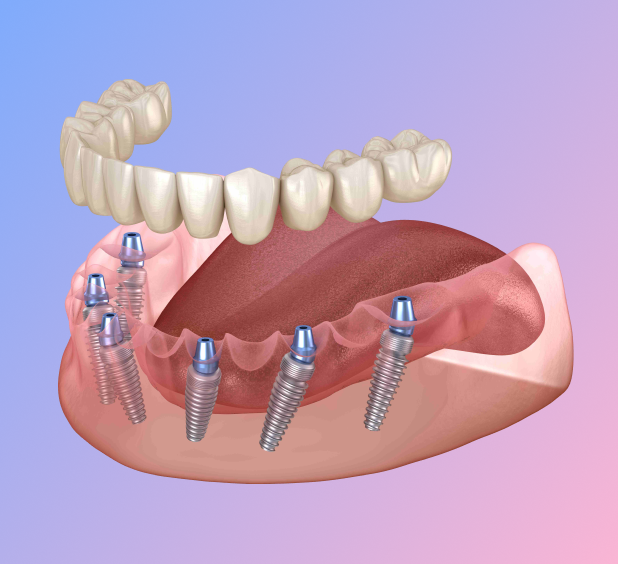 Акция Имплантация под ключ <br><i>в рассрочку</i> в стоматологической клинике Голливуд