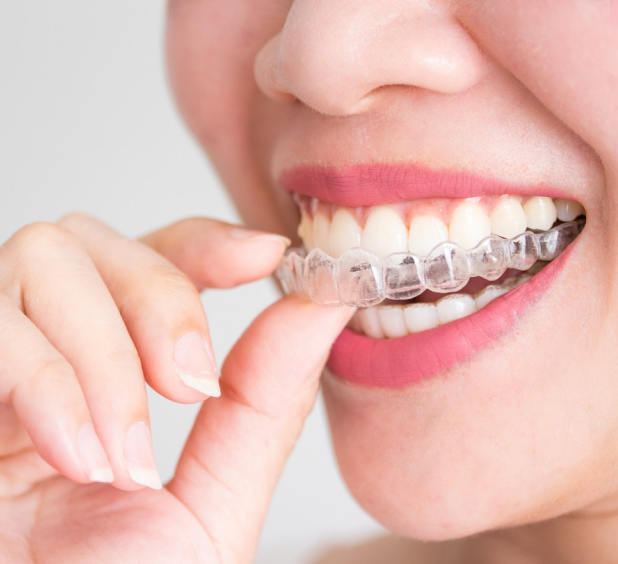 Акция «Исправление прикуса без брекетов» в стоматологической клинике Голливуд