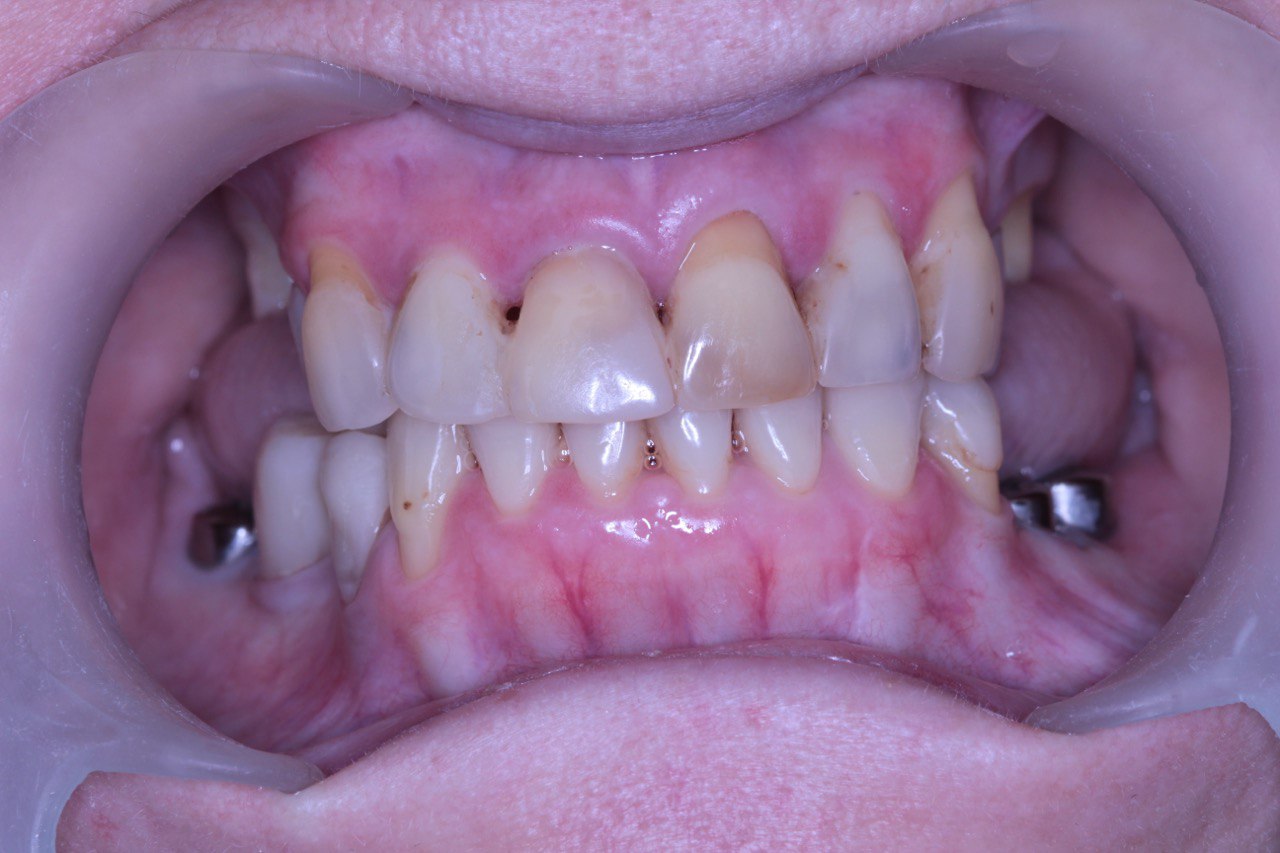 Протезирование зубов