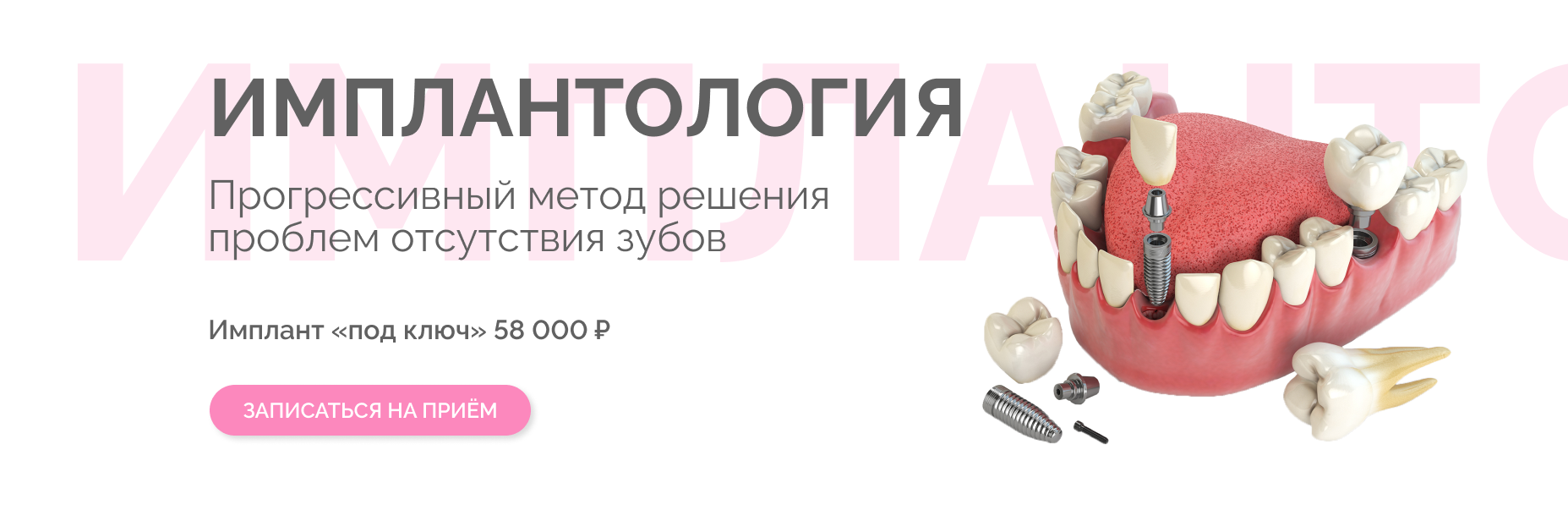 Имплантация зубов «под ключ» Томск Осипова